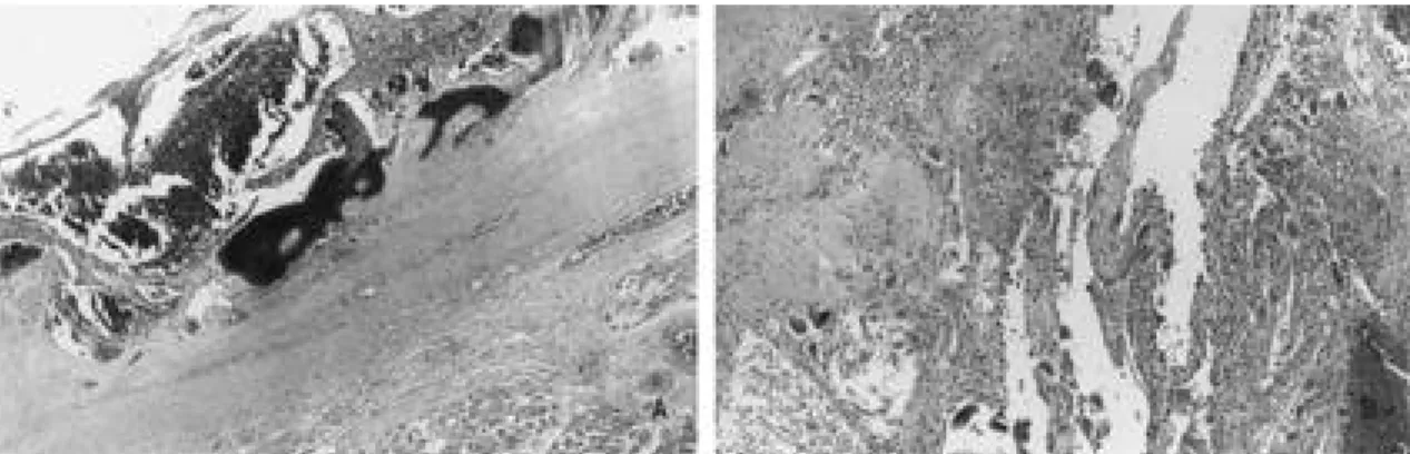Fig 3-B. There are large blood-fillled spaces and fibrous septae containing osteoid, and osteoclast-like giant cells (H&amp;E ×100).