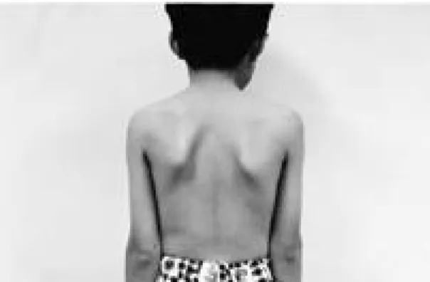 Fig. 3 . Scapular protrusion is not detected when the patient pulls his shoulders back.
