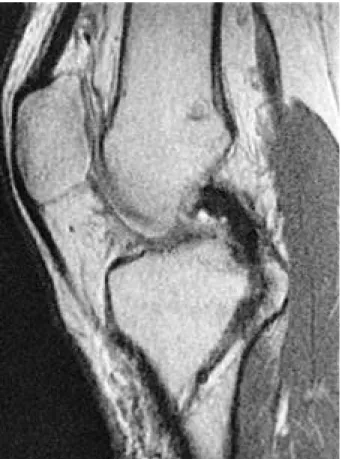 Fig. 5. MRI finding post-op 14 months. The graft shows homogenous, low signal along the whole length and thickening of femoral attachment.