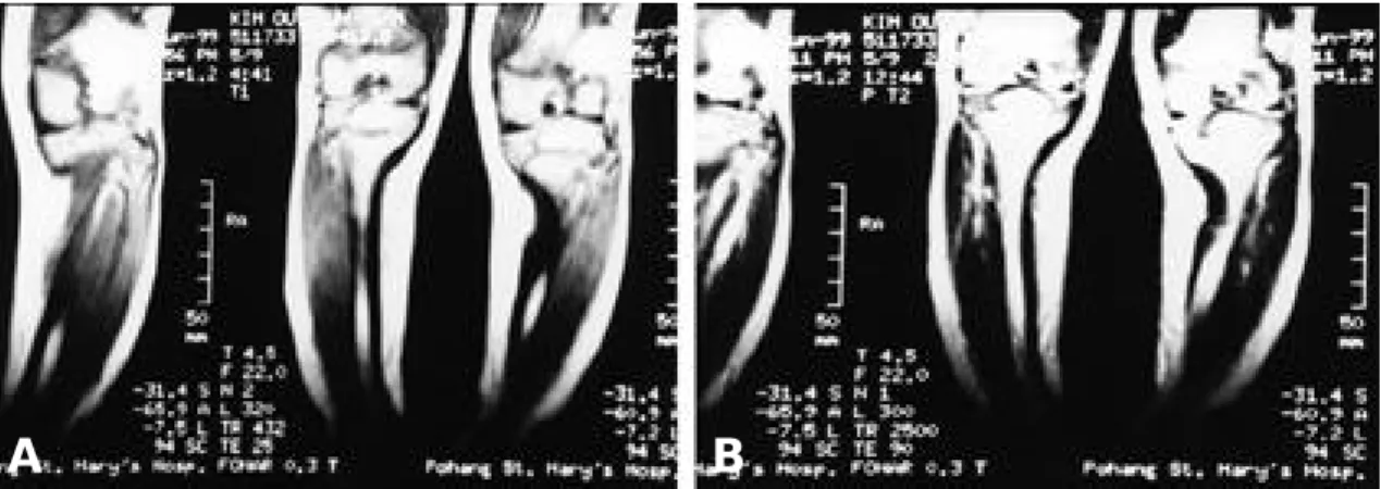 Fig. 3. Anteroposterior and lateral radiographs of left tibia demonstrate that the tibia vara was  correct-ed by osteotomy and bone graft with screws and K-wire.