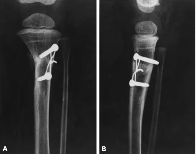 Fig. 5. Postoperative(15 months) anteroposterior and lateral radiographs of left proximal tibia show well union and good alignment state.