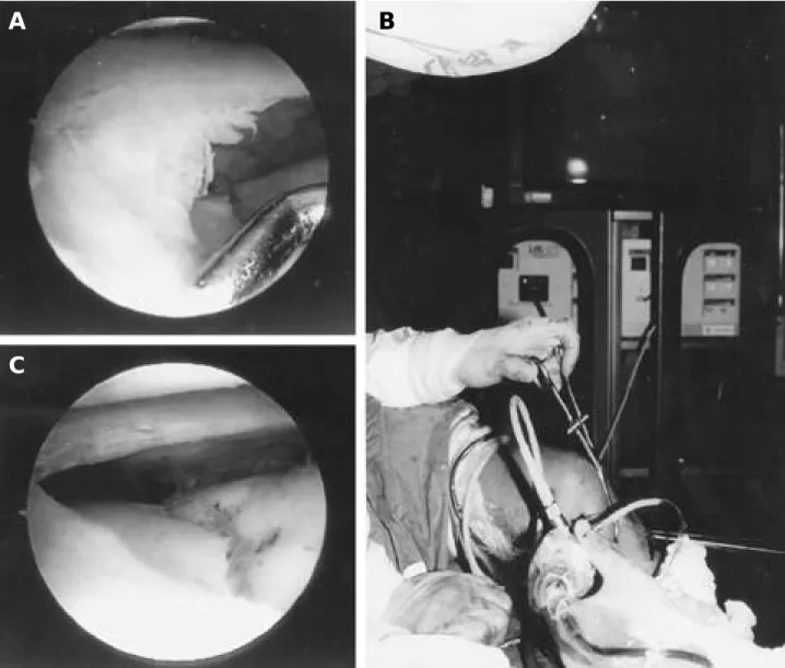 Fig. 1-A. Arthroscopic finding was incomplete longitudinal tear of lateral meniscus and gap of fragment.