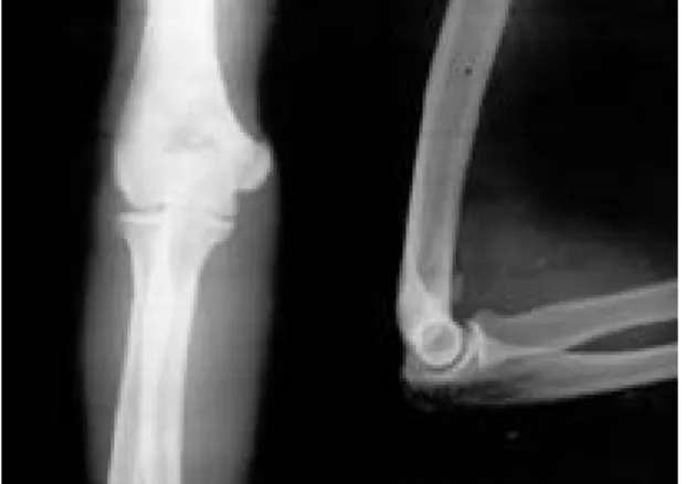 Fig. 2. MR image showing the osteochondral fragment in the capitellum.