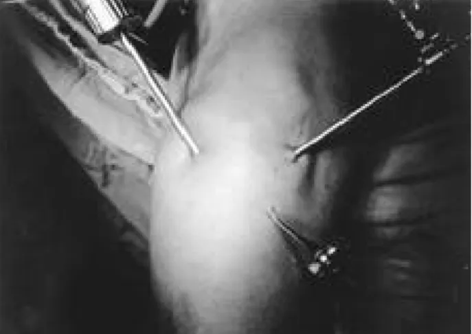 Fig. 1. The arthroscope is inserted through the standard antero- antero-lateral portal of the patient’s left knee