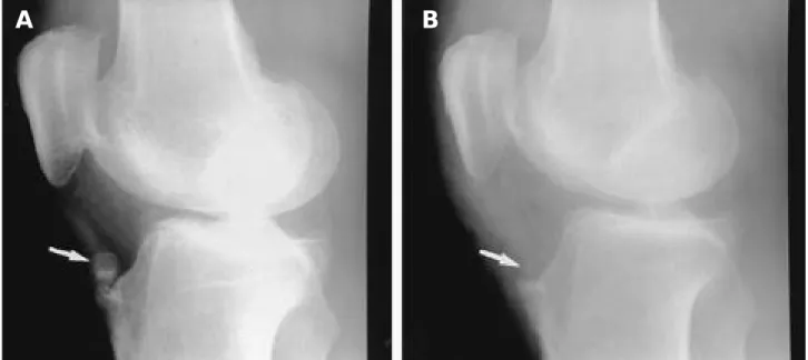 Fig. 3-A. Preoperatively, lateral radiography of 36 year-old male who did not responded to the conservative treatment