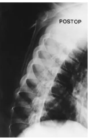 Fig. 4. The postoperative trans-scapula roentgenogram shows no bony protrusion of the ventral surface of the scapular body.