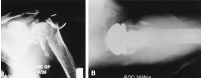 Fig. 1-A. Preoperative radiograph of 36 years old female showed four-part fracture.