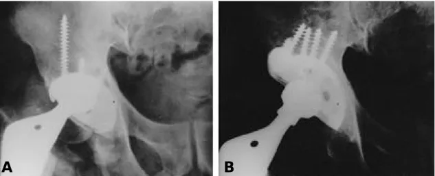 Fig. 2-B. Postoperative radiograph with reinforcement ring acetabular component.
