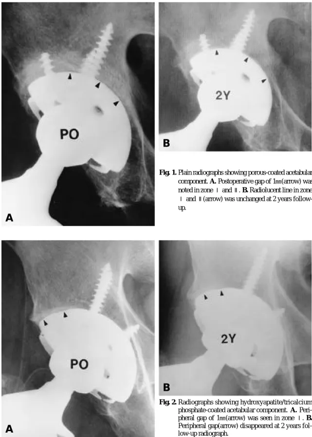 Fig. 1. Plain radiographs showing porous-coated acetabular component. A . Postoperative gap of 1 ㎜ (arrow) was noted in zone  Ⅰ and  Ⅱ 