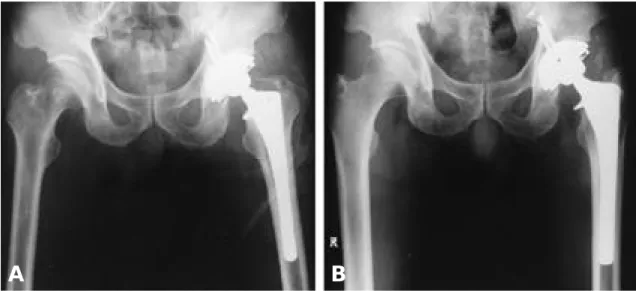 Fig. 4-A. Postoperative AP radiograph of 42-year-old male with Lt hip AVN showed good initial stability