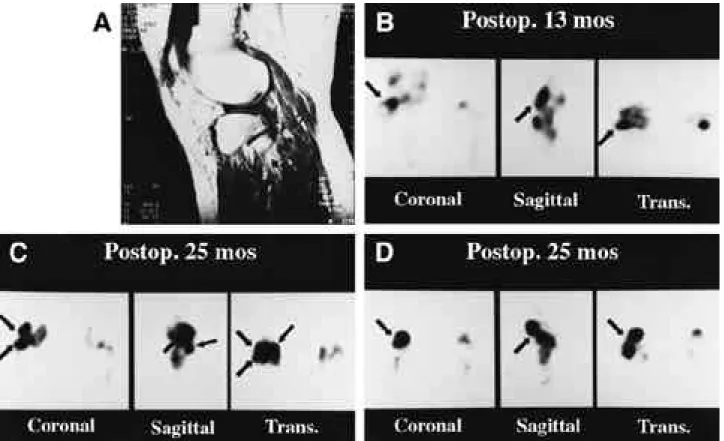 FIGURE 1-A. Geographic bone bruise : Sagittal T1 weighted MR image demonstrated relatively low signal intensity in the areas immediately adjacent to articular cortical bone.