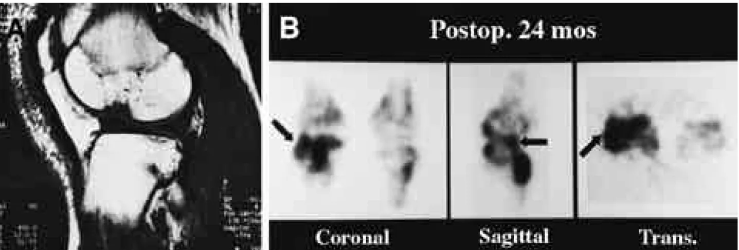 FIGURE 2-B. Bone SPECT after 24 months showed increased uptake at whole lateral compartment.