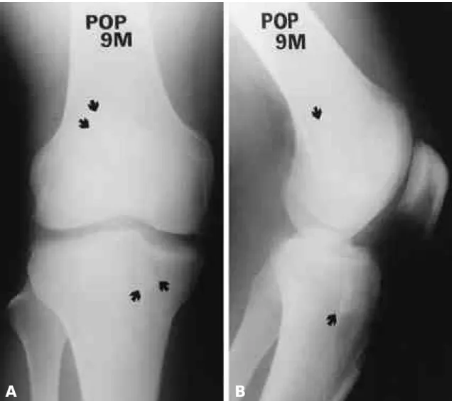 FIGURE 3. Postoperative follow-up AP and lateral radiograph of bioabsorbable interference screw fixation