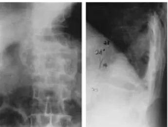 Fig. 2. Whole body bone scan with Tc 9 9 m shows increased uptake of L1 vertebra.