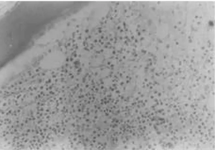 Fig. 6. Material from L1 vertebral body shows infiltration of small lymphocytes and eosinophils.(H-E stain,  × 200)
