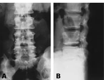 Fig. 2. L3-4, L4-5, L5-S1 discs show low signal in sagittal T2- T2-weighted image. Huge mass of herniated disc are  com-pressing dura from posterior at L4-5.