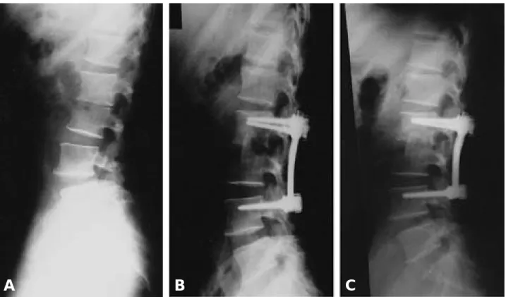Fig. 2. A 44-year-old male with pyogenic spondylitis of L2-3. A. In Preoperative lateral roentgenogram, the sagittal angle is mea- mea-sured as 10o