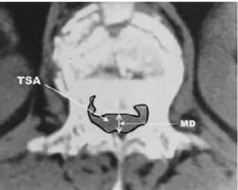 Fig. 1. Transverse Spinal Area(TSA) and Midsagittal AP Dia- Dia-meter(MD).