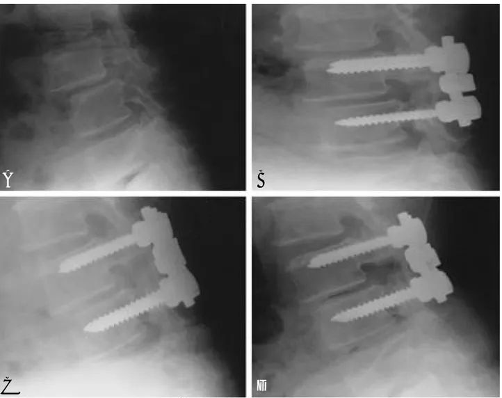 Fig. 1-B. Postoperative lateral radiography of a 41-year-old man treated with posterolateral fusion with pedicle screws shows good reduction state and restoration of disc space.