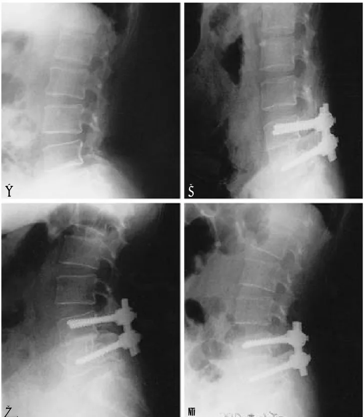 Fig. 2-A. Preoperative lateral radiography of a 37-year-old woman with spondylolytic spondylolisthesis shows anterior slip of the L4 and narrowing of the L4-5 disc space.