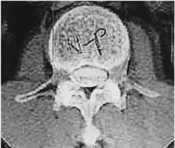 Fig. 1. Computerized digitizing the mathematic superimposed image using the two axial image of the lower lumbar spine from CT at the same level