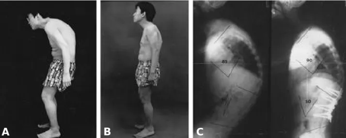 Fig. 2-A~C. The preoperative and postoperative clinical photos and lateral radiographs of the 22 years male patient suffered from ankylosing spondylitis