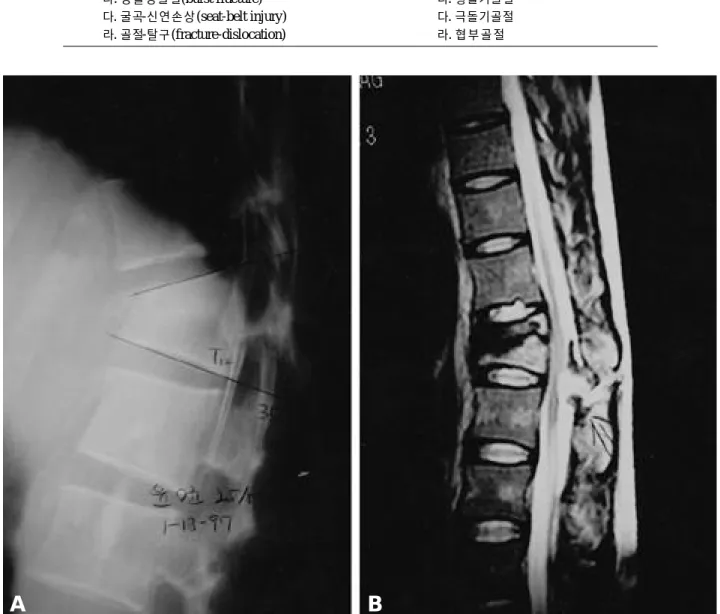 Fig. 1-A. Pre-op. lateral radiograph shows compression fracture of T12 with 35 degrees of wedge angle