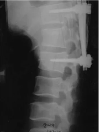 Fig. 2-B. Post-op. myelograms show complete block of dural sac contour at the level of L3-4.