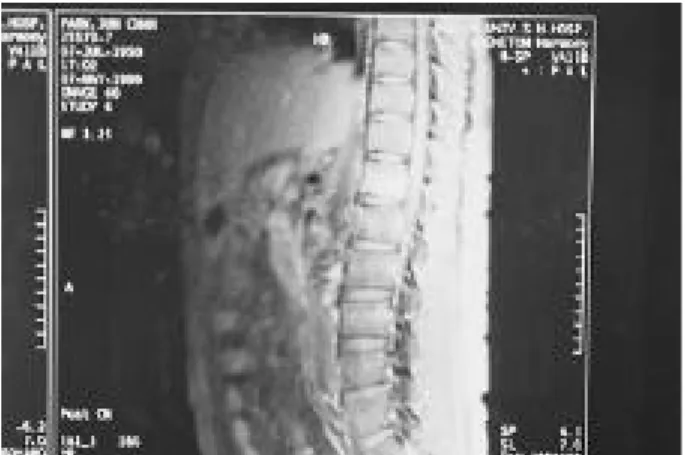 Fig. 2-5. MRI of Tuberculosis spine (coronal view). MRI show  changes  of  intensity  to  center  of  T12 intervertebral body.