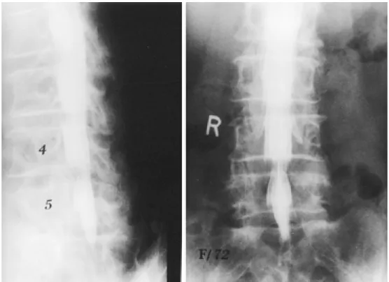 Fig. 1. Lumbar myelogram of a 72-year-old woman showing incomplete filling defect of the right S1 nerve root sleeve.