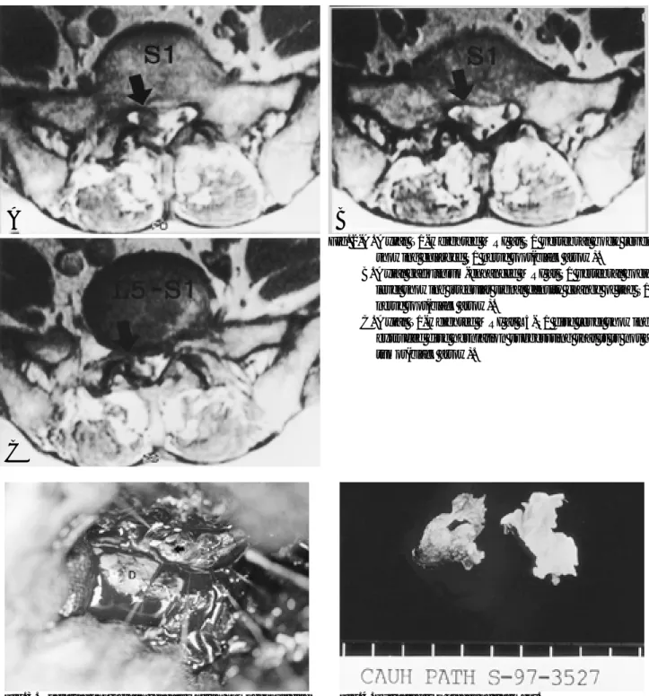 Fig. 2-B. Axial gadolinium-enhanced MRI at S1 vertebral body level showing irregular signal density change of the S1 nerve root(black arrow).