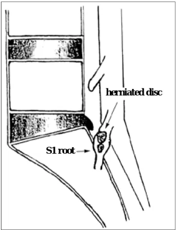Fig. 5. Schematic drawing of intraradicular lumbosacral disc herniation.