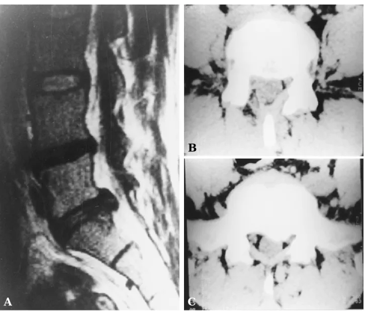 Fig. 1-A. Preoperative saggital MRI showed herniated nucleus purposus on L4-L5, L5-S1 level.