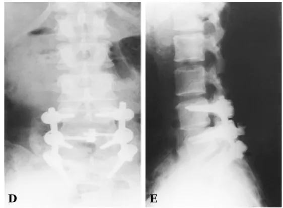 Fig. 2-A. This 44 year-old man suffered from Lt. side radiating pain. Initial MRI showed disc bulging on L4-5 and extruding disc on L5-S1 level