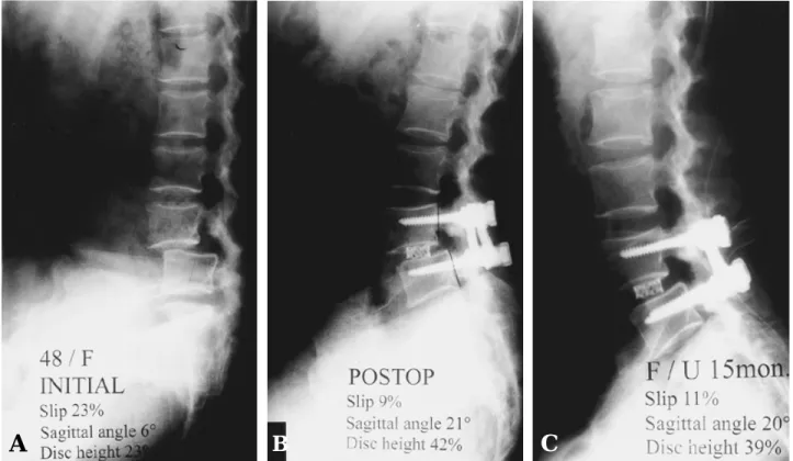 Fig. 1-B. Lateral radiograph after operation showed 9% anterior slippage of the L4 vertebral body, 21°of sagittal angle and 42% of disc height.