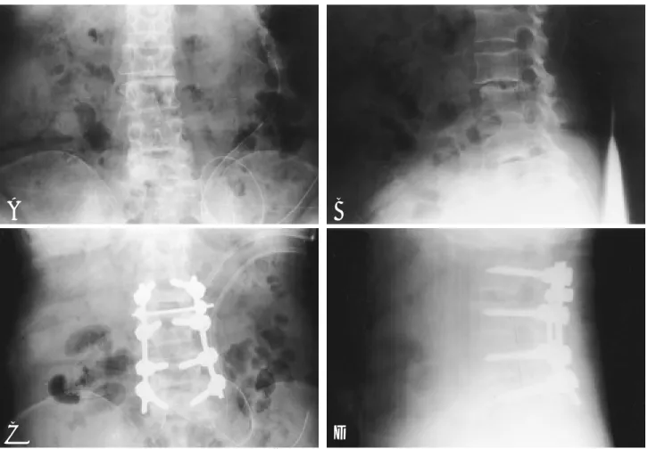 Fig. 2-B. Preoperative lateral radiography of the lumbar spine shows degenerative spondylolisthesis of L2 and L4.