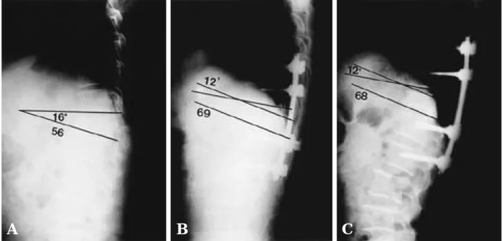 Fig. 2. Radiographs of a sixty-three year old male patient who underwent the T12 bursting fracture.