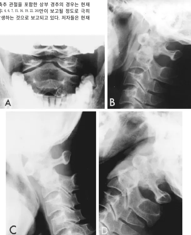 Fig. 1. A and B, Open mouth view and lateral radiograph of the cervical spine showing a small, round ossicle located above the C1-C2 facet joints with a wide gap between ossicle and axis body