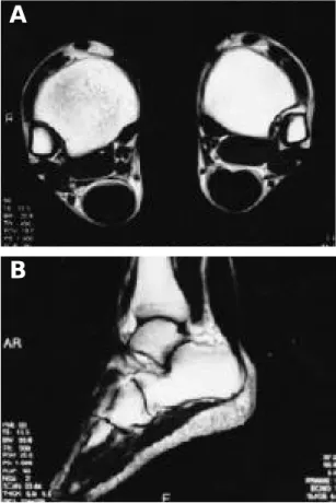 Fig. 1-A. Sagittal T1-weighted MR image shows dif- dif-fuse increase in size of Achilles tendon with parallel vertical striations of increased signal intensity in tendon substance.