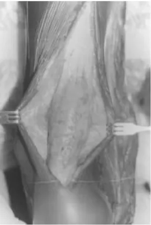 Fig. 3. The photomicrograph of the excised mass (H &amp;