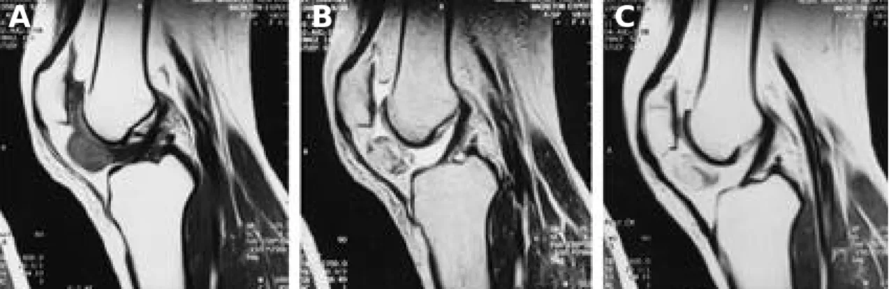 Fig. 1. Rt. knee MRI; The ovoid masslike lesion in the infrapatellar fat pad area, shows isointense on sagittal SE T1- T1-weighted image (A), heterogenously hyperintense sagittal SE T2-T1-weighted image (B), and contrast  enhance-ment with focal noncontras