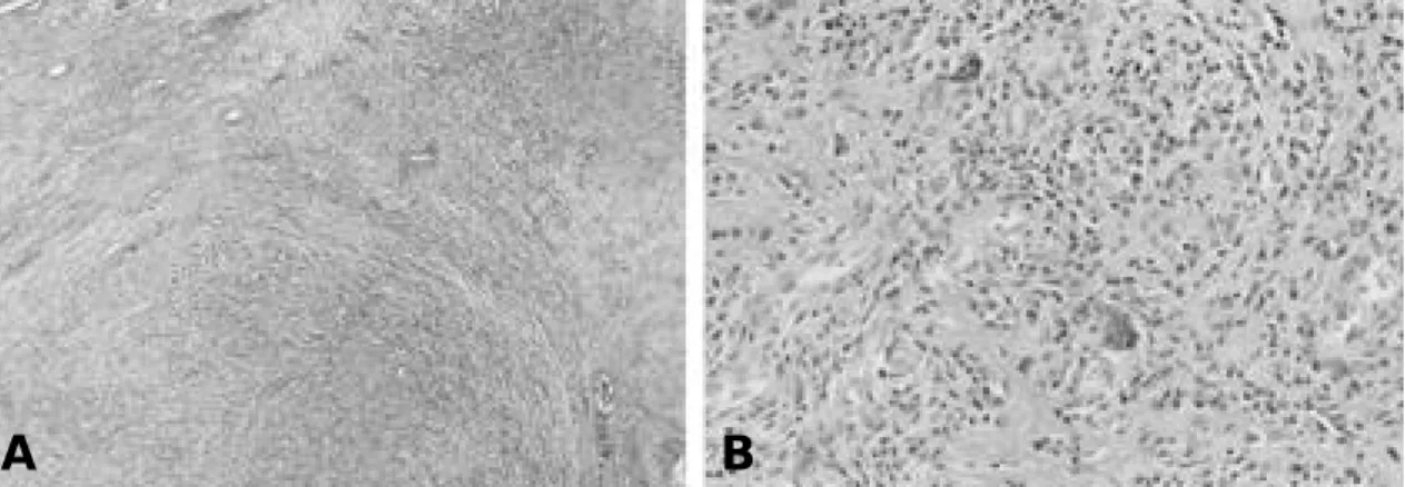 Fig. 2. Microscopic finding of a benign fibrous histiocytoma. A . Characteristically most are composed of spindle cells arranged in fasicular form and round histiocyte like cells(H &amp; E,  × 40)