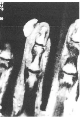 Fig 4 . A. Pathological finding : Polypoid mass of angiomat ou s tissue with the typical epithelial collar ett e (Low pow er , ×40)