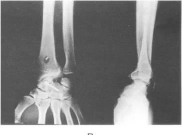 Fig . 1. A . Preop film is showing the marked sclerotic &amp; collapsed osteonecrotic change in lunat e with st age IIIb 