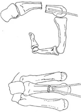 Fig . 1. T his drawing shows the method of reduc- reduc-ing the fr acture by 90 degr ee flexion of the met acarpophalangeal joint .