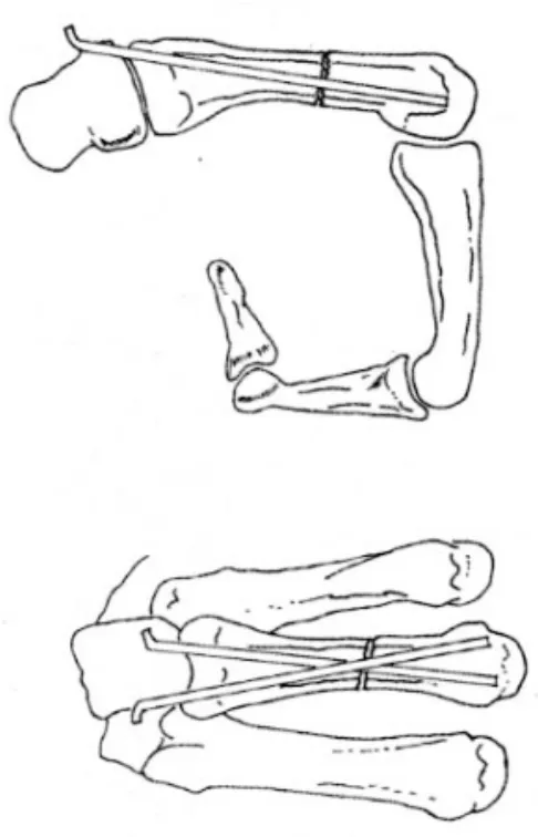 Fig . 4 . After the pins pass the fr acture sit e, the wrist is fully flex ed so that the pins emer ge on the dor sum of the wrist and the distal ends of pins are embeded in the met acarpal head.