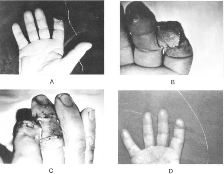 Fig . 1. A. Index finger show s oblique amputation of finger pulp with exposure of bone