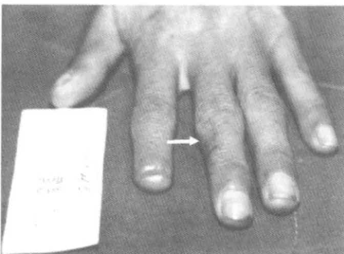 Fig 3 . Index finger tip was also reconstructed by 3rd finger flap(arrow). T he appearance of donor and recipient site are good.