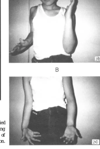 Fig . 2. A- C. End- results after modified Steindler ' s flexorplasty showing 10 o - 90 o of elbow flexion, 40 o of pronation and 30 o of supination.