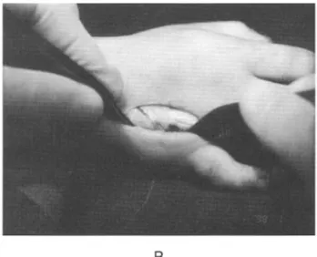 Fig . 5 . K- wire inserted to support the corrected position of abduction in bilaterally involved 3 year old boy which was silicone inserted case.